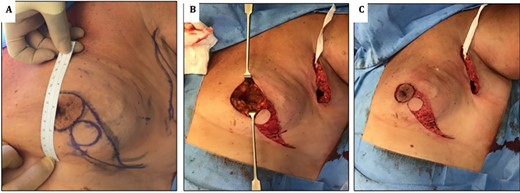 (A) images showing preoperative markings of modified Grisotti flap. Note the short nipple to IMF crease length, which would significantly shorten further if a standard Grisotti technique were undertaken. (B) En bloc resection of NAC and tumour creating a significant defect. (C) Harvesting of modified Grisotti flap with de-epithelialization of the skin surrounding the flap with preservation of the medial triangle skin (delimitated superiorly by the areola and inferiorly by disc of skin to be rotated).