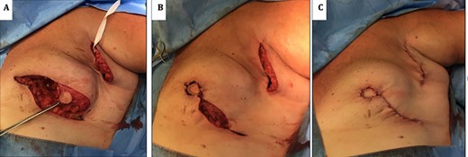 (A) image showing standard undermining of the lateral aspect remaining glandular tissue to facilitate advancement and rotation into central defect. (B) Insetting of modified Grisotti flap. (C) Closure of donor site and completion insetting of flap.