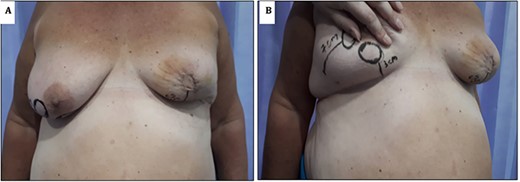 (A) Image showing 1-week post-operative results; note the maintenance of neo-nipple to IMF crease distance of 6 cm. (B) Contralateral breast showing location of standard Grisotti disc; note the relatively short NAC-IMF of 3 cm that would result if this technique were undertaken.