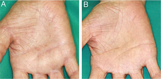 (A) Palmoplantar pustulosis appeared before tonsillectomy. (B) The pustules are disappeared 3 months after the surgery.
