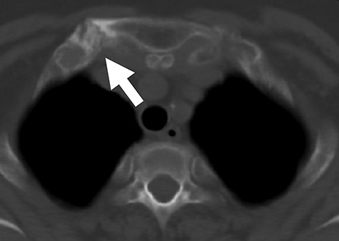 Axial CT image demonstrating thickened right sternoclavicular joint (white arrow). CT, computed tomography.