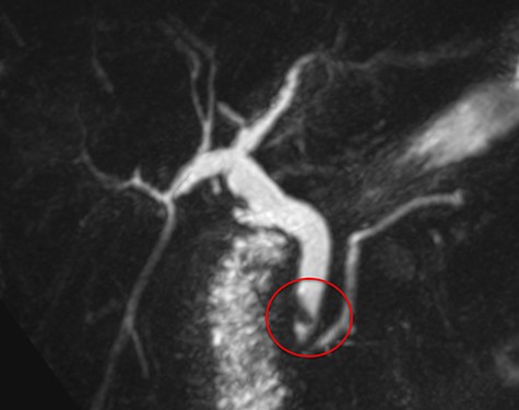 Magnetic resonance cholangiopancreatography (MRCP) showing a filling defect in the distal bile duct (red circle).