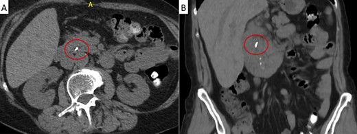 Abdominal CT scan. A metallic artifact is observed in the distal common bile duct (red circle) in axial (A) and coronal (B) planes.