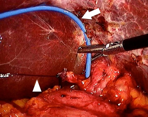 Four trocars were used, one in the umbilicus (12 mm), another in the epigastrium (5 mm) and two in the right hypochondrium (5 mm). An Endoloop ligature (arrowhead) is placed in the isolated cystic stump and exteriorized in the right hypochondrium for traction. This facilitates the incision in the cystic stump and the transcystic biliary exploration with endoscopic hose-type biopsy forceps (arrow).