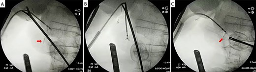 Laparoscopic transcystic extraction under intraoperative radiological guidance. Without any contrast injection to facilitate titanium visualization, the metallic clip (red arrow) is recognized in the distal CBD (A), caught with the endoscopic forceps (B) and finally removed from the CBD through the cystic duct (C).