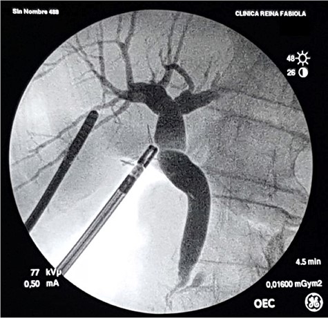 Control intraoperative cholangiography using a 5-Fr catheter and an Olsen clamp demonstrates free flow of contrast into the duodenum without defects or stenosis.