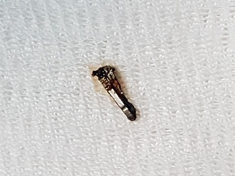 The metallic clip is recognized enclosed in biliary sludge. Notice that the clip is closed but both branches cross, denoting an incorrect closure.