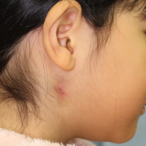 An 8-year-old girl had a chronic induration below her right mandibular angle.