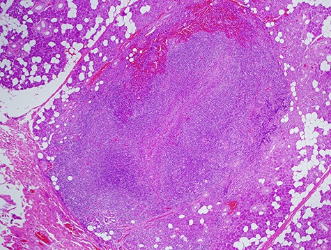 Histological specimen of the final surgery. Inflammatory reaction of a lymph node inside of parotid the parotid gland was observed.