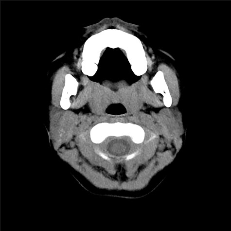 CT scan taken prior to the first visit. There can be seen subcutaneous induration, but no cysts nor fistula was obvious.