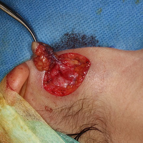 A string-like structure was observed below the induration, during the first surgery.