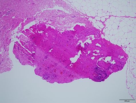 Histological specimen showing the string-like structure. No epithelial cells were observed by the pathologists.