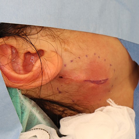 Swollen sub-aural region, just prior to the drainage incision.