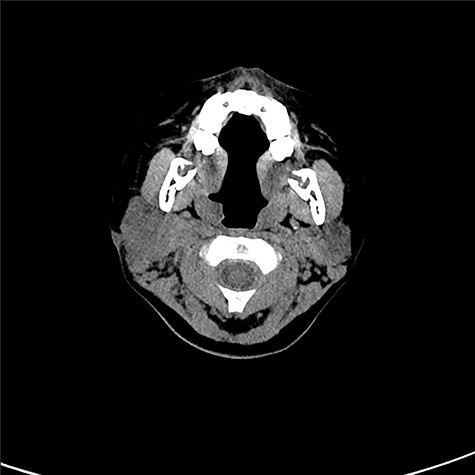 Cystic lesion could not be observed by CT scan prior to the drainage.