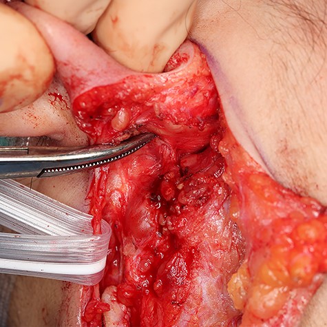 A cord structure is pointed by a mosquito clamp. Great auricular nerve was yanked with a Penrose drain.