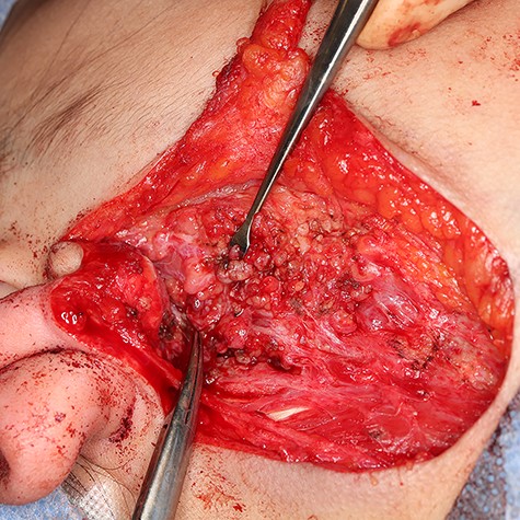 Facial nerve branches were preserved and pointed by a mosquito clamp.