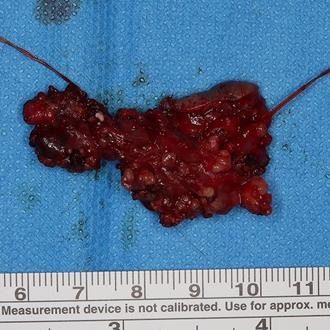 Extracted parotid gland specimen. Strings were tied to the cord structure.