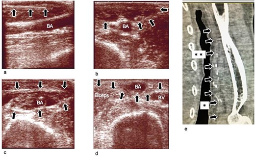 Ultrasound images obtained during and after the operation, (a) Ultrasound image obtained during infusion of TLA solution into subcutaneous tissue. The needle is clearly seen (arrow mark). (b) Ultrasound image obtained after infusion of the TLA solution into the subcutaneous tissue. The subcutaneous tissue becomes edematous (arrow mark). (c) Ultrasound image obtained after infusion of the TLA solution around the BA. The compartment becomes edematous. The BA is dissected from the fascia surrounding it. (d) Ultrasound image obtained 3 weeks after the operation. The BA is transposed to the subcutaneous layer, which is superficial to the brachial fascia (arrow). (e) Plane computed tomography image obtained 4 weeks postoperatively. The BA (arrow marks) is transposed to the subcutaneous layer. The transposed lesion was between arrow marks with * and **. The transposed length was 10 cm, and the depth of the lesion was 2 mm, which was just beneath the skin. BA: brachial artery; BV; brachial vein; TLA: tumescent local analgesia.