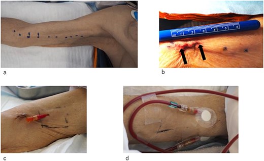 Photographs of the right upper arm obtained before and after the operation. (a and b) The position of the BA is marked on the skin. The operation is performed through a 2-cm incision. The incision is indicated by arrow mark. (c and d) The BA and cephalic vein are safely cannulated with a 16-gauge needle.