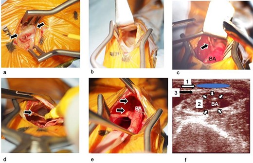 Photographs and schematic images of the operative method. (a) The BA is exposed through the incision. The surrounding tissue is edematous due to injection of the TLA solution but did not interfere with surgical procedures. (b) The subcutaneous tissue and brachial fascia are dissected using a retractor and a pair of forceps. (c) The BA is dissected from the surrounding tissue including the brachial fascia, brachial vein and brachial nerve. The branches are ligated with a ligation clip. Arrow mark; branches of the BA. (d) The brachial fascia is cut. Arrow mark; brachial fascia, which is being cut. (e) The brachial fascia is closed with barbed absorbable sutures beneath the BA. Arrow mark: suture line of the brachial fascia (f) Schematic overview of procedures performed using cross-section ultrasound imaging. First, the subcutaneous tissue was dissected, and a subcutaneous tunnel was created (area ‘1’). Second, the BA was dissected from the surrounding tissues. The branches of the artery are ligated and divided (area ‘2’). Third, the brachial fascia above the BA was cut (membrane ‘3’). Finally, the fascia beneath the BA was closed; the BA was transposed to the subcutaneous tunnel. BA: brachial artery; TLA: tumescent local analgesia.
