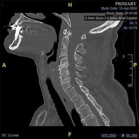 Midline sagittal CT scan of the cervical at the time of first presentation.