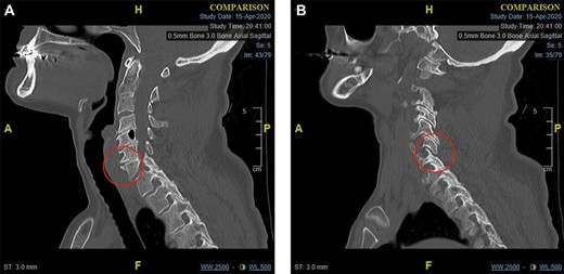 (a) Para-midline sagittal CT scan of the cervical spine at the time of first presentation showing a fracture of the antero-superior osteophyte of C7 (indicated with a circle). and (b) Para-midline sagittal CT scan of the cervical spine at the time of first presentation showing opening of the C6/C7 facet joint (indicated with a circle).