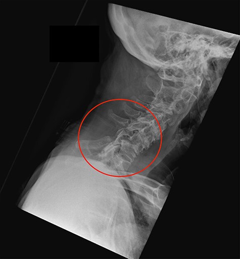 Lateral cervical spine radiograph at the time of representation with the level of injury indicated.