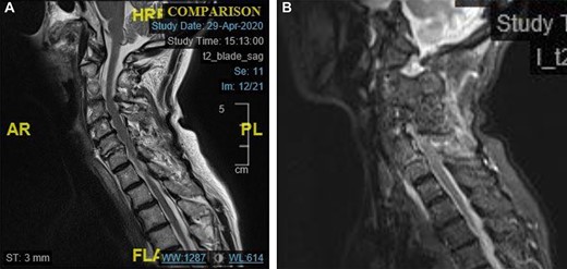 (a) Midline sagittal T2 weighted MRI image showing high signal in the C6/7 disc space. (b) Midline sagittal short-t1 inversion recovery weighted MRI image showing high signal in the posterior elements of C4–C7.
