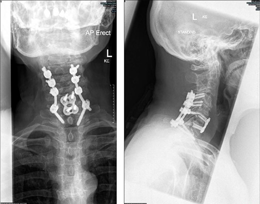 Radiographs (antero-posterior and lateral views) of the cervical spine following instrumentation.