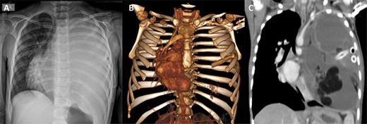 (A) Preoperative chest X-ray showing total atelectasis of the left lung and deviation of the cardiac silhouette to the right. (B) CT scan showing deviation of the cardiac silhouette to the right. (C) Heterogenic density tumor multiloculated of the left hemithorax, which probably originated in the mediastinum and extended to the whole left pleural space with displacement of the mediastinum to the right