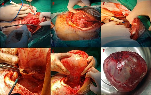 (A) Resection of the mediastinal mass via a median sternotomy associated to left anterior thoracotomy. (B) Entry into the pleural space was performed through the sixth intercostal space. (C) Many adhesions to thoracic wall and diaphragm were found. (D) Phrenic nerve presented adhesions to the tumor. Also, it had founded a nutritional artery depending on left internal mammary artery. (E) Section of the left internal mammary vessels, dissection of the phrenic nerve, ligation of the nutritional vessel, mediastinal tumor excision, ligation of the thymic vessels and thymectomy was performed. (F) The mediastinal tumor, excised in block, was red–gray colored, well circumscribed and capsuled with a size of 15 × 15 × 20 cm