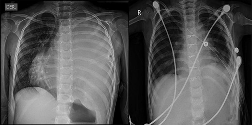 (A) Preoperative chest X-ray showing total atelectasis of the left lung and deviation of the cardiac silhouette to the right. (B) Postoperative Day 9 chest X-ray after total resection of the teratoma, showing re-expansion of the left lung