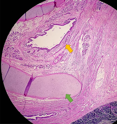 Anatomical pathology test showing the presence of glandular epithelial cells (yellow arrow) concomitant with the presence of cartilage tissue (green arrow)