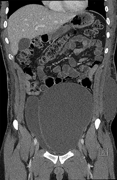 CT abdomen pelvis performed preoperatively (coronal)