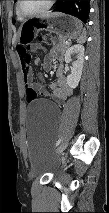 CT abdomen pelvis performed preoperatively (sagittal)