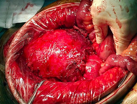 Intraoperative findings