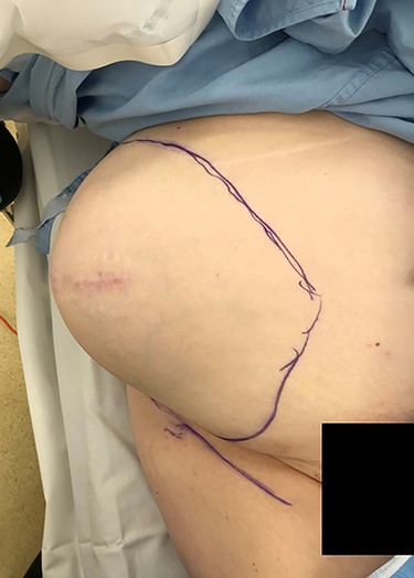 Preoperative photograph of the large right flank hernia.