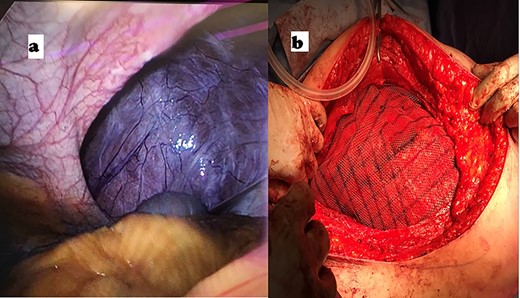 (a) Laparoscopic intraperitoneal view of abdominal defect; (b) placement of large Ultrapro mesh in sublay position.