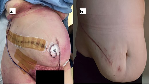 Postoperative photograph of the wound on day of surgery (a) and at 24 weeks (b).