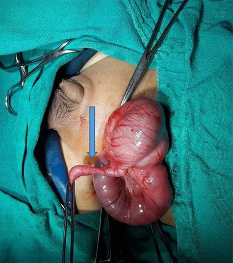 Arrow showing appendix as a content of hernia sac.