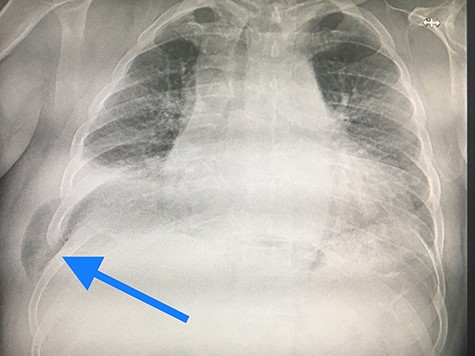 Chest radiography showed hazy airspace opacity, highly suspicious for lung herniation.