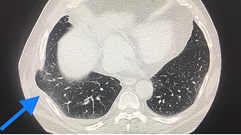 CT scan, lung herniation in the right hemithoracic, with clear position of the lung between the ribs and under the muscle straits.