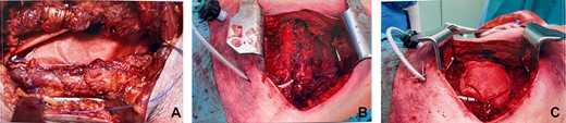 (a) Insertion of the bovine pericardium mesh in sublay position and fixtation with continuous sutures, (b) the reinforced chest wall closure with pericostal sutures and (c) the onlay Insertion of the bovine pericardium mesh and the insertion of Redon catheters over the sublay inserted mesh and under the ICS.