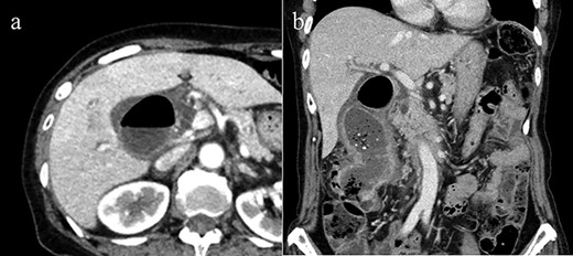 (a) Axial CT image reveals pneumobilia and wall thickness of the gallbladder, but did not show fistulous connection with the colon clearly. (b) Coronal view of CT demonstrates CCF. No CT imaging angle could clearly show the tumorous lesion.