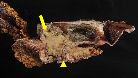 Gross appearance reveals tumor mass within the gallbladder (arrow), adhesion between gallbladder and adjacent colon and fistulous formation (arrowhead).