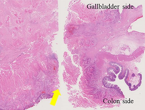 Invasion of gallbladder’s squamous cell carcinoma to the transverse colon and formation of the cholecystcolonic fistula (arrow).