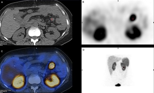 SPECT/CT Octreotide imaging. (A) A CT cross-section view indicating the location of the malignant lymph node. (B) A SPECT cross-section of the same plane indicating high uptake over the Region of Interest. (C) A combined view of SPECT/CT with superimposed images demonstrating hotspot over the malignant lymph node. (D) Octreotide SPECT coronal view showing the position of the malignant lymph node.