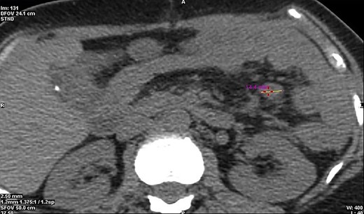 CT cross-section illustrating a diameter of 14.4 mm of the malignant neuroendocrine tumour.