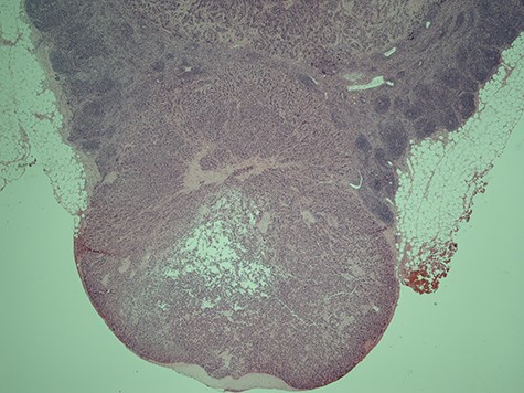 Histological slice of the specimen acquired on the second lymph node removal.