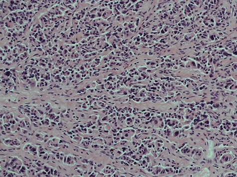 A histological slice of the resected second lymph node tumour; viewed under x20 power.